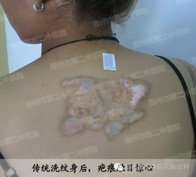 洗纹身实拍:数分钟解决纹身难题