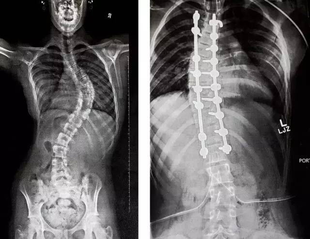 脊柱侧弯可能会毁了孩子一生--怎样确定孩子是否存在脊柱侧弯?