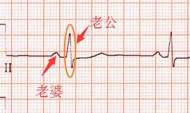 彻底晕菜…… 其实,心电图可以这么学 比如: 房室传导阻滞 ▼ 注意