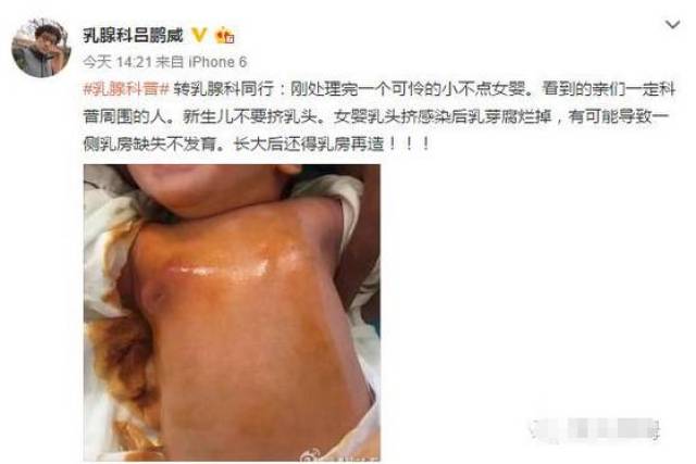 女宝宝需要挤奶头吗？不要因为自己的无知害了宝宝！