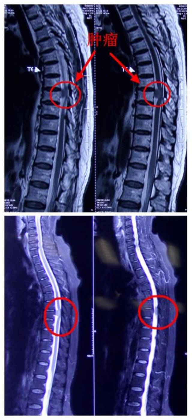 病例:手术治愈胸椎管内脊膜瘤一例