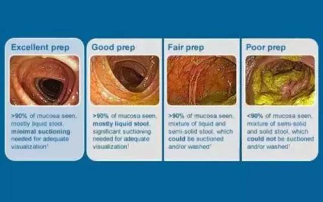 做肠镜,你准备好了么?