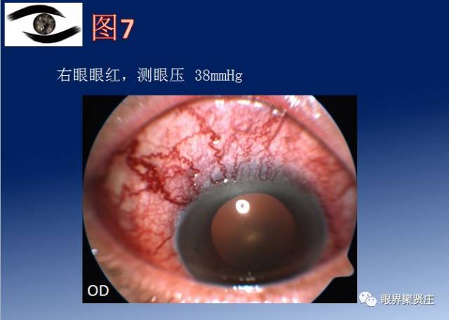 ct图像可见双侧眼眶多条眼外肌肌腹增粗显著,眶尖拥挤,已压迫视神经