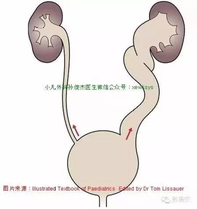 上图:表示后尿道瓣膜,瓣膜上方的尿道扩张,膀胱增厚小房小梁形成,输