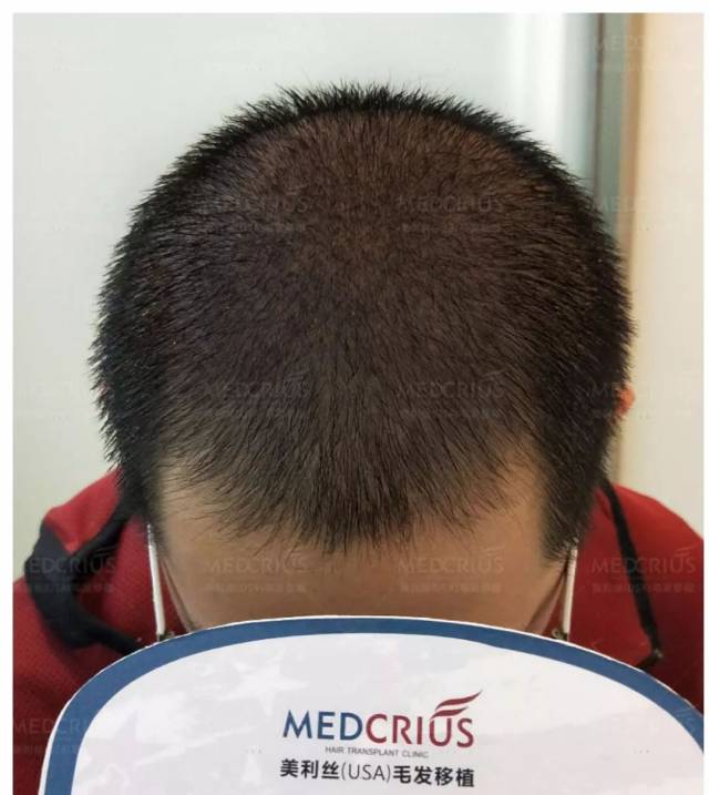 梦见头发一抓一大把一大把的掉，还从掉落的头发里钻出很多虫子好像有