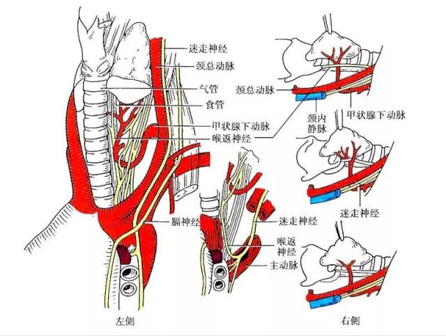 喉返神经离甲状腺很近,如果手术将其损伤,可造成喉返神经麻痹,单侧