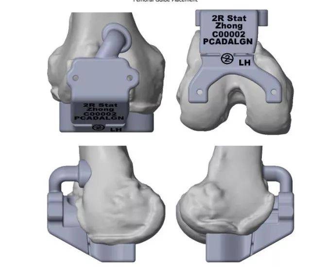 市一院完成全国首例wright 3d打印截骨工具膝关节置换术