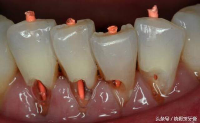 如果是轻度酸性腐蚀,缺损不大还能复合树脂填充,遇到重度腐蚀露出牙髓