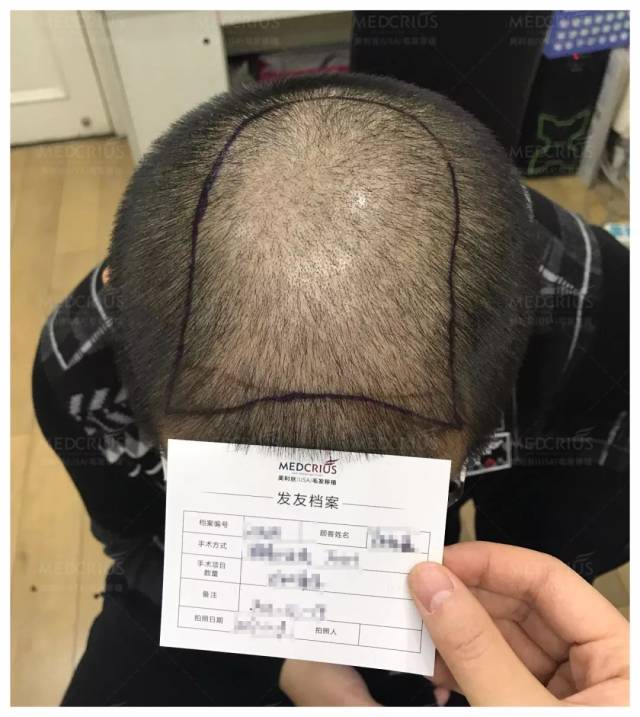 梦见自己的头发一把一把的掉，探索梦境背后的深层含义