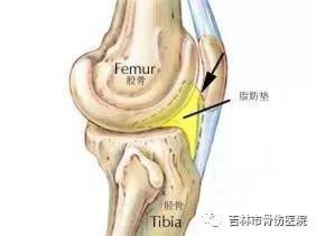 膝关节痛久治不愈——被忽略的髌下脂肪垫