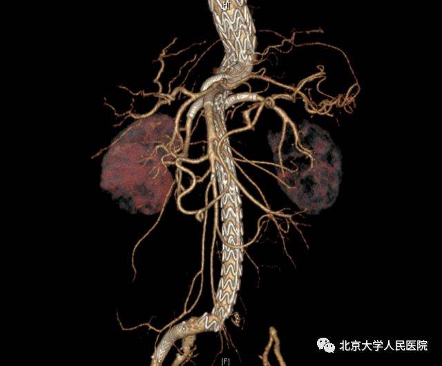 体内"定时炸弹"拆除记 我国内首例多分支支架技术治疗复杂腹主动脉瘤