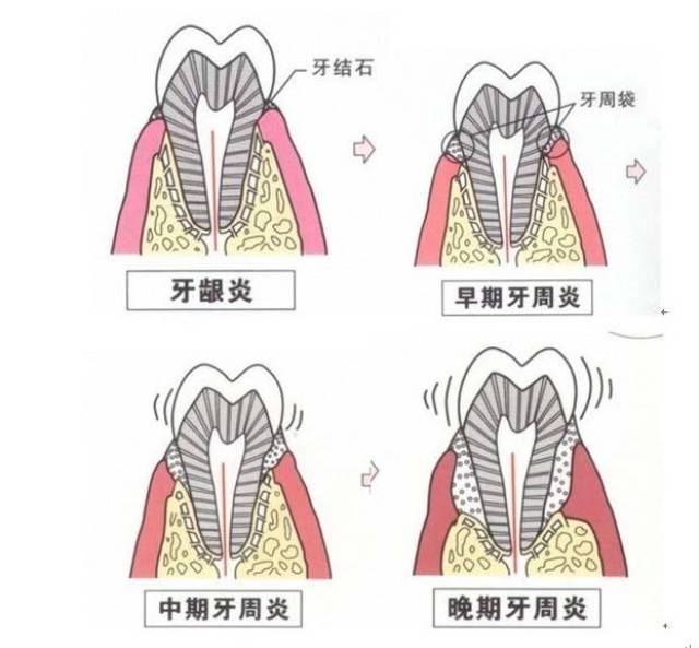 牙龈出血警示六大问题