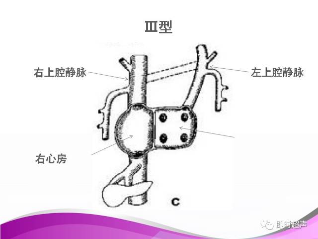 胎儿永存左上腔静脉的超声诊断