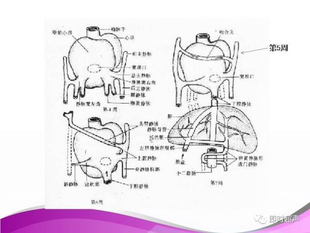 胎儿永存左上腔静脉的超声诊断