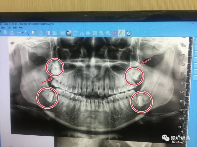 (圆圈所示为智齿,箭头所示为多生齿)