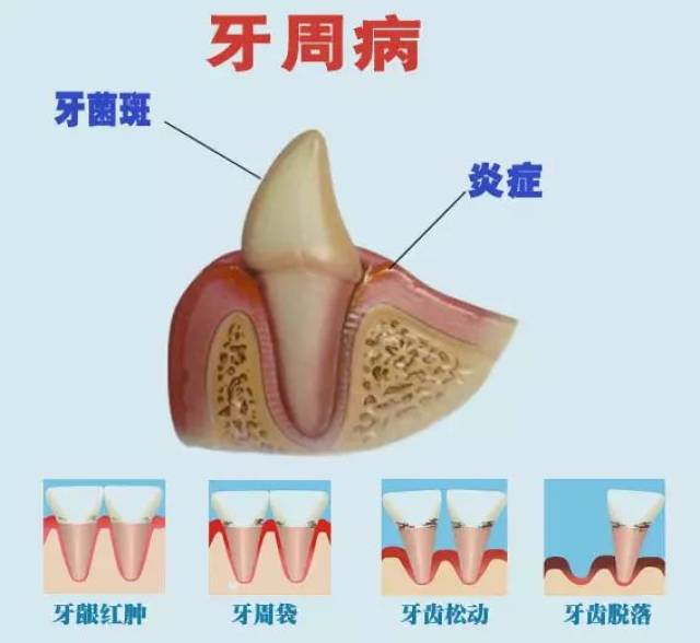 临床要表现为牙周袋形成,牙龈炎症,牙周附着丧失,牙槽骨吸收以及