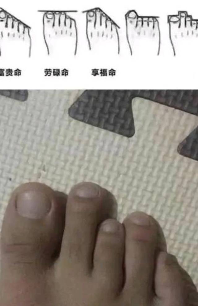 网友:这脚是畸形吧,应该去医院看看