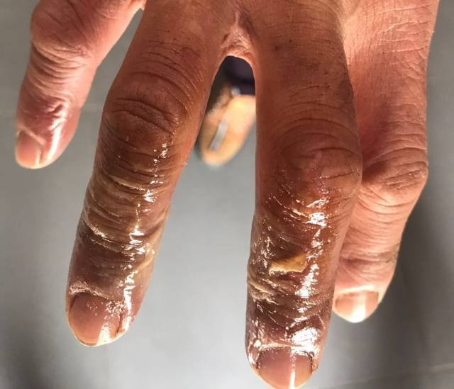 这是一位养护师傅的手 因为帮车主拧开爆缸的盖子 一只手从手指到