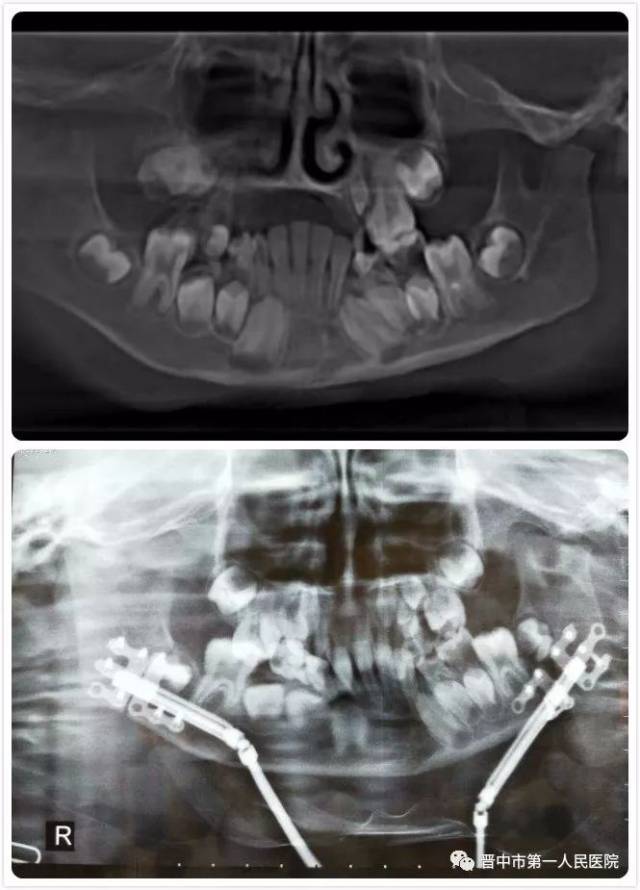 【医院动态】口腔科成功实施我省首例小儿下颌骨严重发育不足双侧下颌