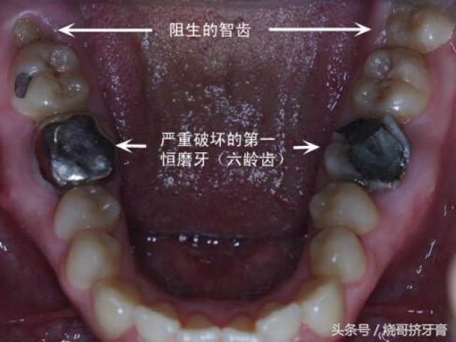 智齿变这样必须得拔除,否则连隔壁牙齿都烂掉!