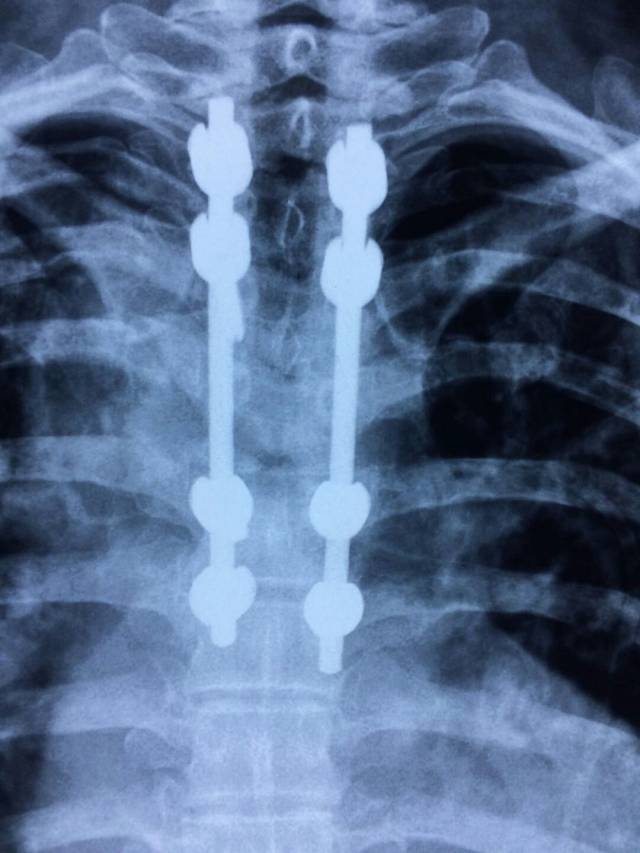 大冶市中医医院骨二科为一名胸椎严重骨折患者成功开展手术