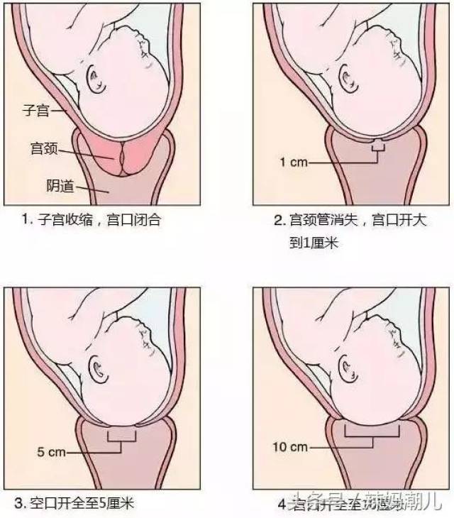 通常以一个指头1厘米来说,开十指,指的是宫口开了10厘米.