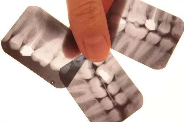 拍X光片到底有多大辐射,我们来探探究竟!