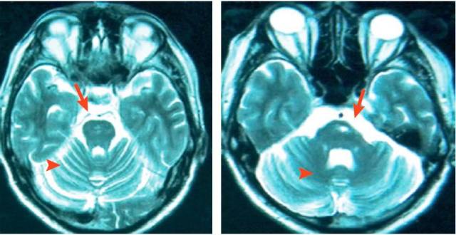 【健康科普】经常性口腔溃疡,小心得了