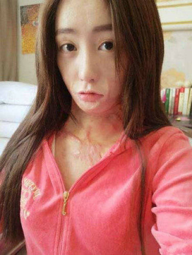 她因拒绝官二代求爱,而惨遭大面积烧伤,如今破茧成蝶活出自己