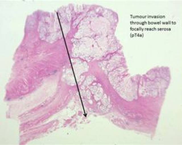 右半结肠切除术病理标本,肿瘤侵犯贯穿肠壁全层局部到达浆膜(pt4a)