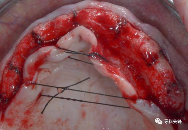 【病例】上颌CAD\/CAM义齿手术的压电种植位点预备