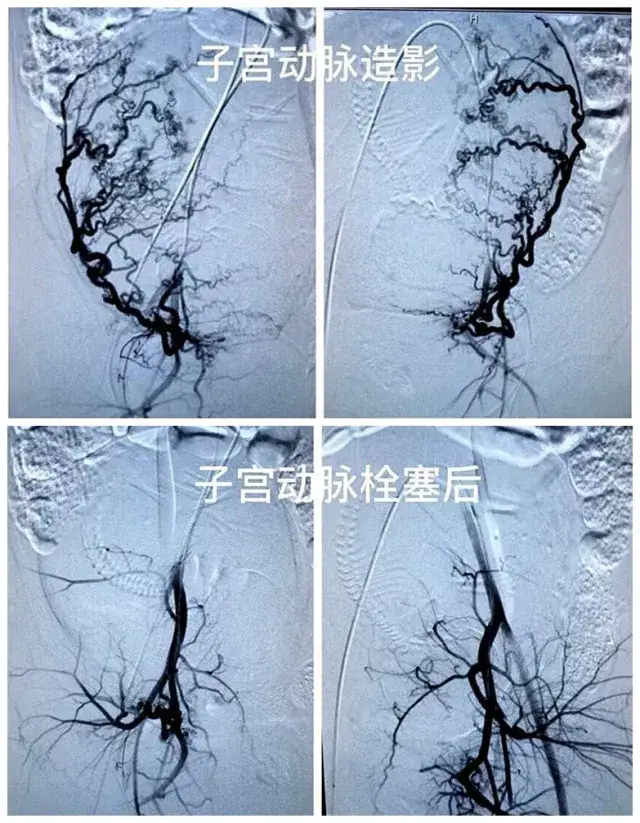 小栓塞大作用—子宫动脉栓塞术