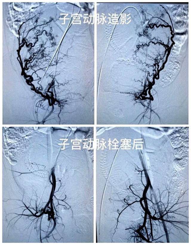 一定量的栓塞颗粒将子宫肌瘤供血血管及正常子宫动脉分支的一定末梢