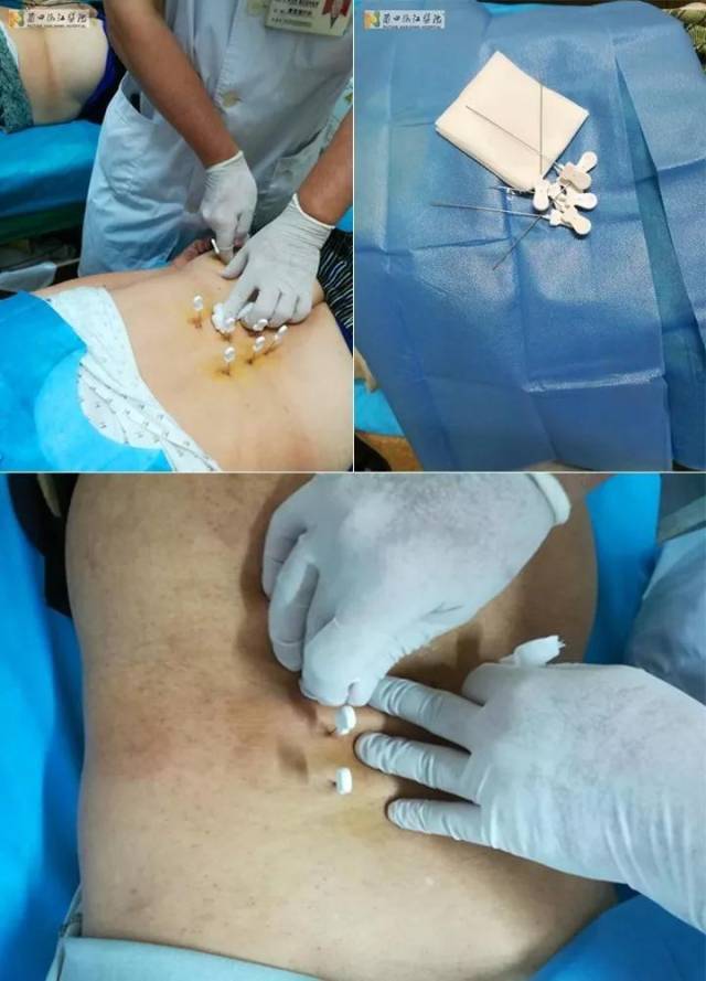 9次针刀治疗后,症状消失,无明显阳性体征,左下肢直腿抬高实验80
