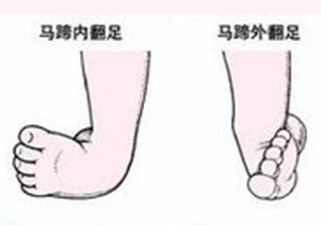 治疗:先进行手法按摩,将足部畸形矫正到接近正常的位置后给予石膏