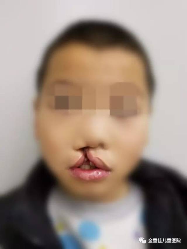 9岁男孩先天性唇腭裂三度,一期手术修复成功!