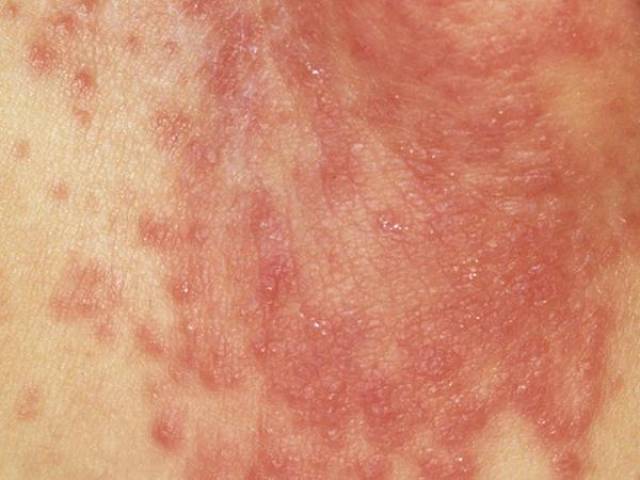 分辨宝宝湿疹,口水疹,尿布疹儿童皮疹及各种皮肤状况的特征(附照片