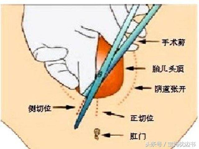 侧切和撕裂哪一个好一点?