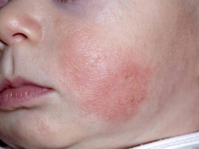 分辨宝宝湿疹,口水疹,尿布疹儿童皮疹及各种皮肤状况的特征(附照片