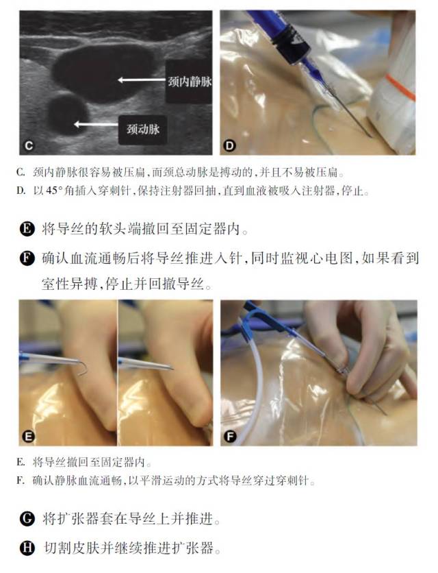 斯坦福麻醉操作图集:如何做好超声引导中心静脉穿刺