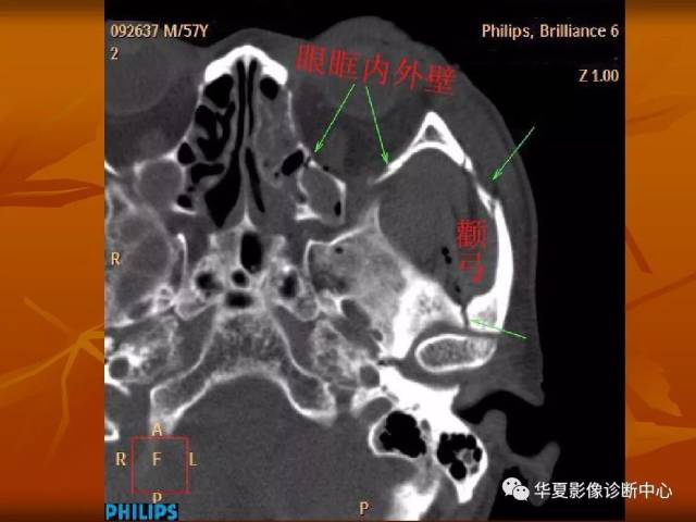 最全的颅骨ct解剖及外伤骨折的诊断