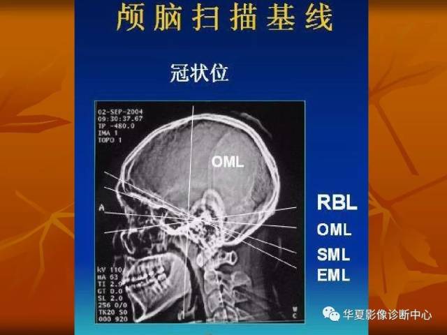 最全的颅骨ct解剖及外伤骨折的诊断