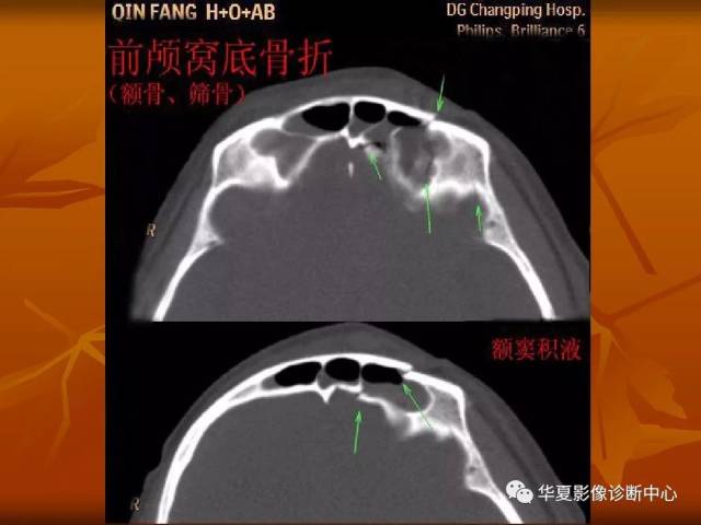 最全的颅骨ct解剖及外伤骨折的诊断