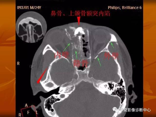 最全的颅骨ct解剖及外伤骨折的诊断