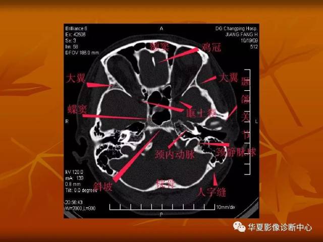 最全的颅骨ct解剖及外伤骨折的诊断