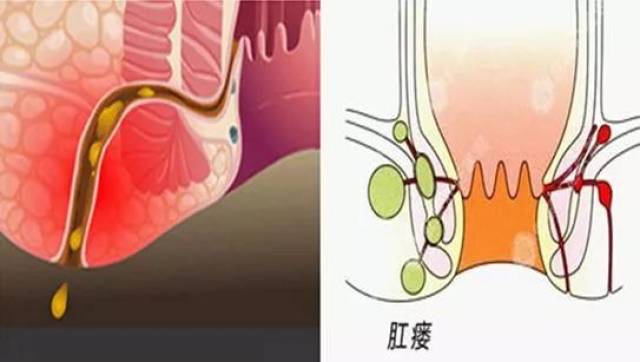 【疾病与预防】肛周脓肿溃破后,99%会引起肛瘘_手机