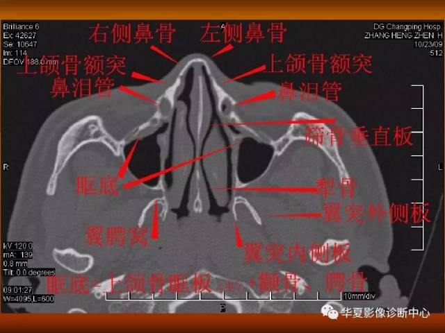 最全的颅骨ct解剖及外伤骨折的诊断