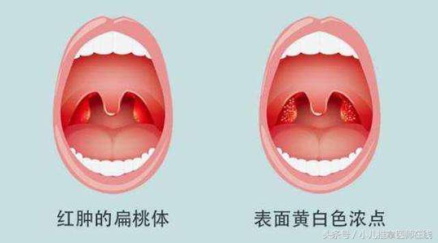 扁桃体发炎和腺样体肥大是一回事吗?需要做手术吗?_手机搜狐网