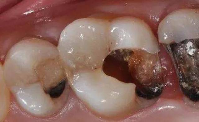 牙齿分为三层,最外层是坚硬的牙釉质,不会感觉到疼痛;中间的牙本质