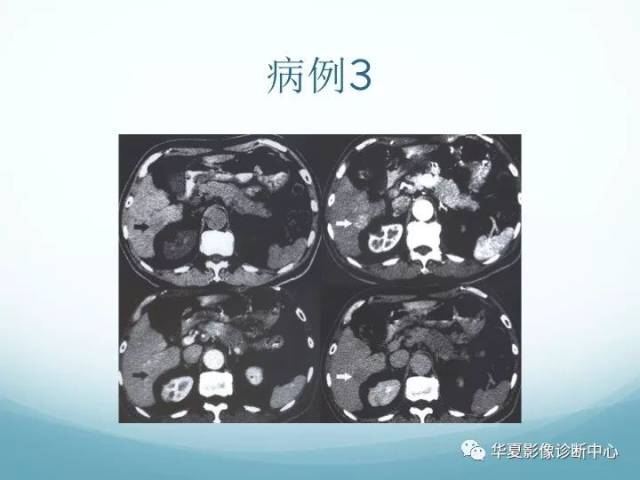 小肝癌少见的ct增强表现
